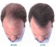 画像3: 送料無料・Kirkland Signature Hair Regrowth Treatment Extra Strength for Men 2-pack　カークランド ミノキシジル 2本＜スポイト付＞ (3)