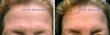 画像5: Facial Smoothies Wrinkle Remover Strips シワ取り テープ - 即効性 シワ対策 ケア クリア (5)